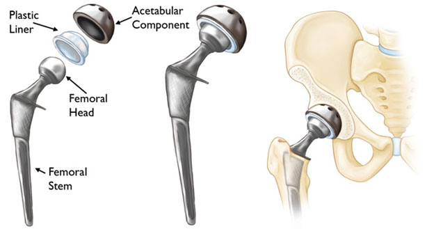 Hip Replacement