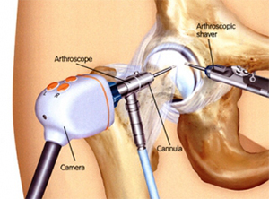 What is hip arthroscopy and is it right for me?