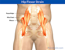 What is hip arthroscopy and is it right for me?