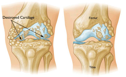 Knee Replaement Image