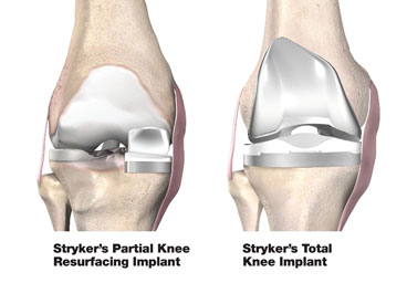 Knee Replaement Image