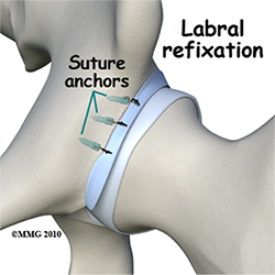 What is hip arthroscopy and is it right for me?